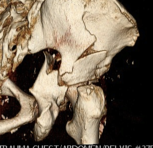 Acetabular Fracture 3D CT Posterior Column